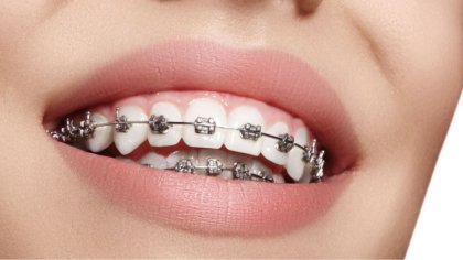 Ostrów Mazowiecka - Jeszcze nie tak dawno osoby noszące aparaty ortodontyczne na