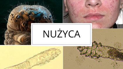 Ostrów Mazowiecka - Nużyca jest chorobą wywoływaną przez niewielkie pasożyty - n